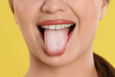 Young woman showing tongue with white patches on yellow background, closeup. Oral candidiasis (thrush) disease
