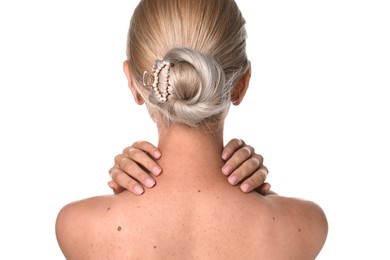 Woman with birthmarks on white background, back view
