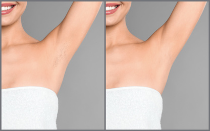 Collage of woman showing armpit before and after epilation on light grey background, closeup 