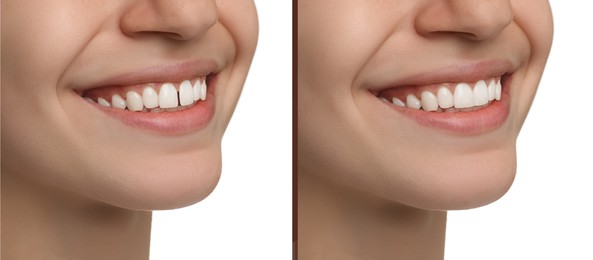 Collage with photos of woman with diastema between upper front teeth before and after treatment on white background, closeup. Banner design