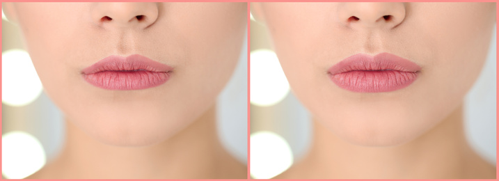 Woman before and after lip correction procedure, closeup. Banner design 