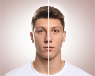 Image of Teen guy with acne problem before and after treatment on light background, collage