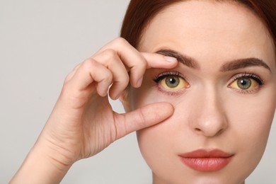Photo of Woman with yellow eyes on light grey background. Symptom of hepatitis