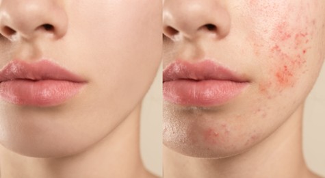 Collage with photos of teenage girl with acne problem before and after treatment, closeup. Banner design