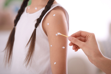Mother applying cream onto skin of her daughter with chickenpox at home, closeup