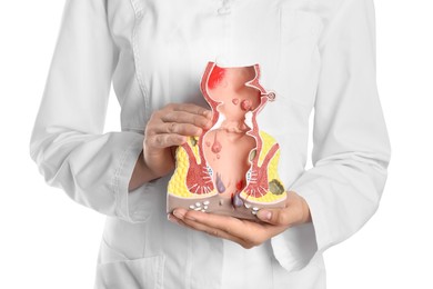 Photo of Doctor holding model of unhealthy lower rectum with inflamed vascular structures on white background, closeup. Hemorrhoid problem