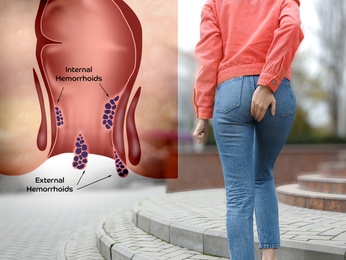 Image of Woman suffering from hemorrhoid pain outdoors, back view. Illustration of unhealthy lower rectum