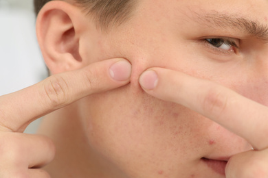 Teen guy with acne problem squeezing pimple on his face, closeup