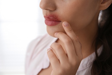 Woman with herpes touching lips against light background, closeup