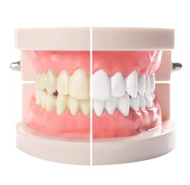 Model of oral cavity with teeth before and after whitening on white background