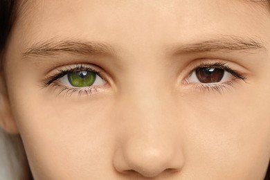 Little girl with different colors of eyes, closeup. Heterochromia iridis