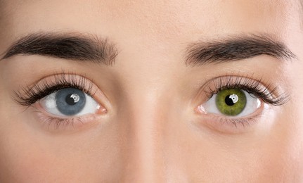 Woman with different colors of eyes, closeup. Heterochromia iridis