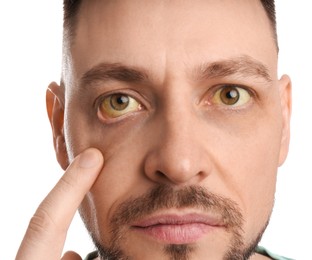 Man checking his health condition on white background, closeup. Yellow eyes as symptom of problems with liver