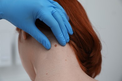 Dermatologist examining patient's birthmark in clinic, closeup view