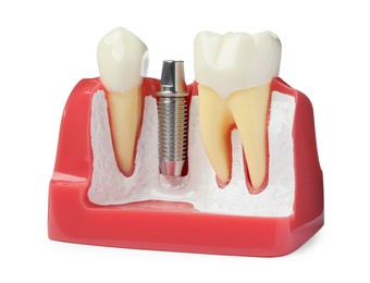 Educational model with post and abutment of dental implant between teeth on white background