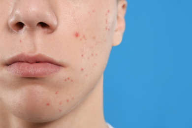 Teen guy with acne problem on blue background, closeup
