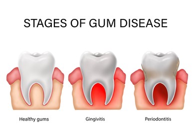 Illustration of Collage with illustrations of healthy tooth with gum and infected ones showing stages of disease. Gingivitis and periodontitis