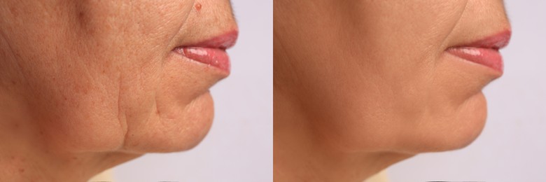 Image of Woman before and after rejuvenating procedures. Collage with photos on white background, closeup