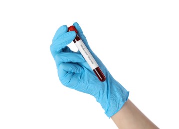 Photo of Monkeypox virus diagnosis. Laboratory worker holding test tube with blood sample on white background, closeup