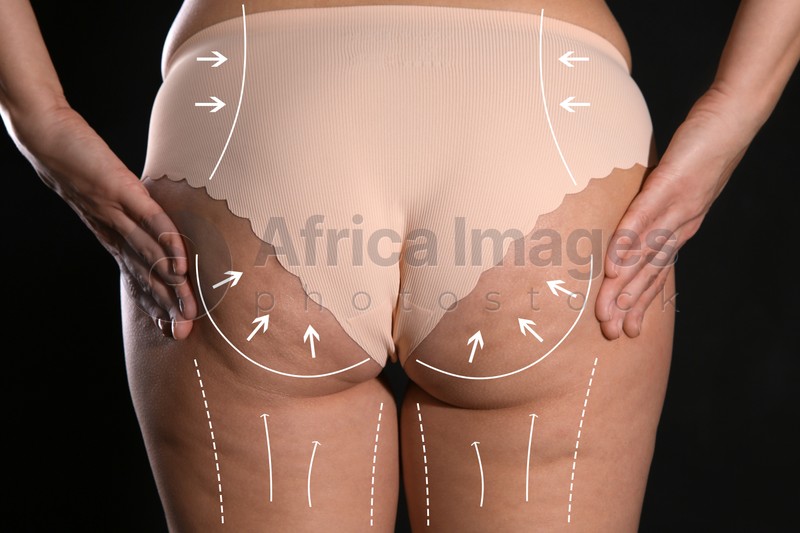 Woman with marks on body before cosmetic surgery operation on black background, closeup