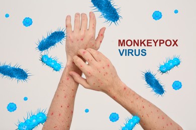 Image of Man with rash suffering from monkeypox virus on beige background, closeup