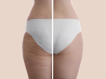 Collage with photos of woman before and after anti cellulite treatment on beige background, 