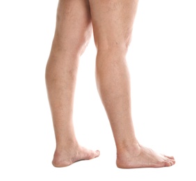 Photo of Woman's legs with varicose on white background, closeup