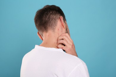 Photo of Man with rash suffering from monkeypox virus on light blue background, back view