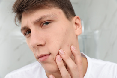 Teen guy with acne problem indoors, closeup