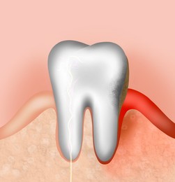 Illustration of Infected gum and tooth, illustration. Periodontal disease