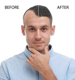 Image of Man before and after hair loss treatment on white background, collage