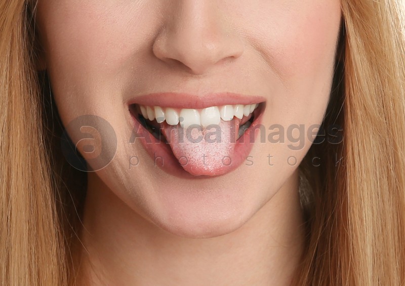Young woman showing tongue with white patches, closeup. Oral candidiasis (thrush) disease
