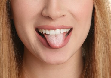 Young woman showing tongue with white patches, closeup. Oral candidiasis (thrush) disease