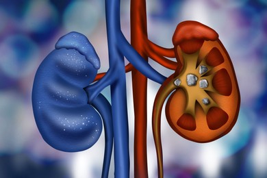 Illustration of Illustration of healthy and diseased kidneys on blue background