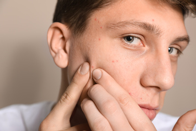 Photo of Teen guy with acne problem squeezing pimple on beige background, closeup