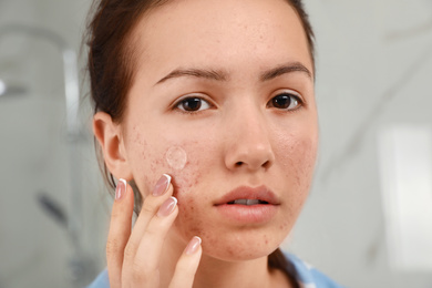 Photo of Teen girl applying acne healing patch indoors, closeup