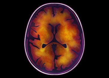 Scan of injured human brain with injured area on black background, illustration