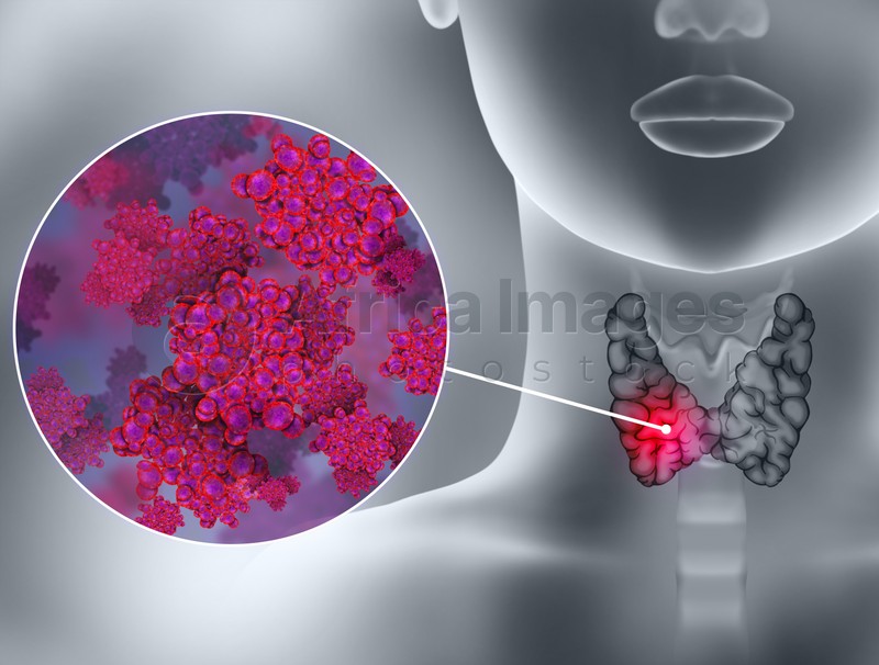 Illustration of human thyroid cancer on grey background