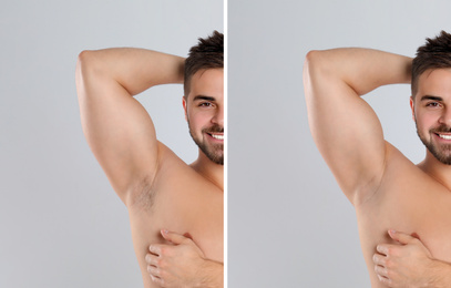 Collage of man showing armpit before and after epilation on light grey background