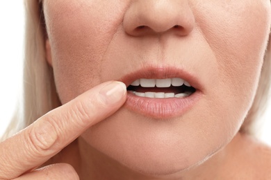 Woman with cold sore applying cream on lips against white background, closeup