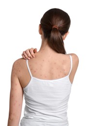 Woman with rash suffering from monkeypox virus on white background, back view