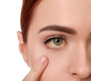 Woman with yellow eyes on white background, closeup. Symptom of hepatitis