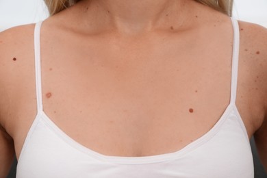 Closeup view of woman's body with birthmarks on white background