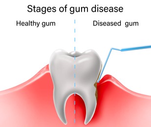 Illustration of Collage with illustrations of healthy tooth with gum and diseased ones. Gingivitis and periodontitis