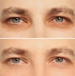 Collage with photos of tired man with dark circle under eye and after rest, closeup