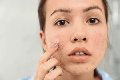 Photo of Teen girl applying acne healing patch, closeup