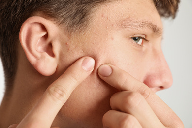 Photo of Teen guy with acne problem squeezing pimple on his face on light background, closeup