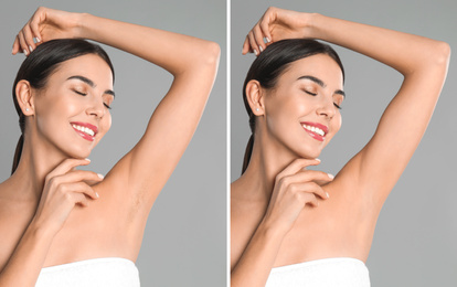 Image of Collage of woman showing armpit before and after epilation on light grey background