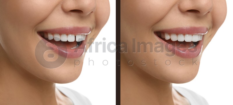 Collage with photos of woman with diastema between upper front teeth before and after treatment on white background, closeup. Banner design