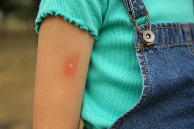 Girl with insect bite on arm outdoors, closeup